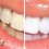 Home remedies for teeth whitening learn how much is teeth whitening