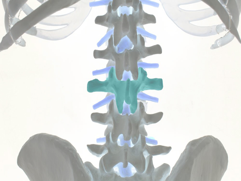 Bulging Disc Treatment Bulging Disc Treatment