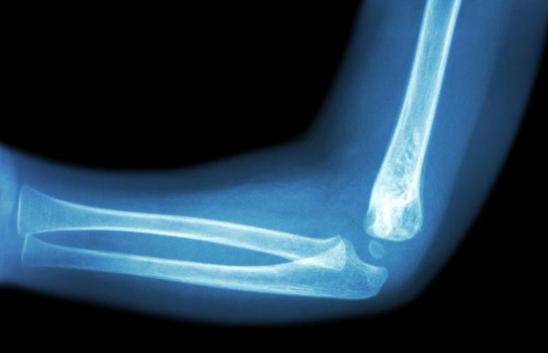 Pain position elbow pain position