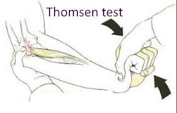 Thomsen test Thomsen test