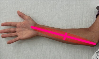 golf elbow humeral medial epicondylitis
